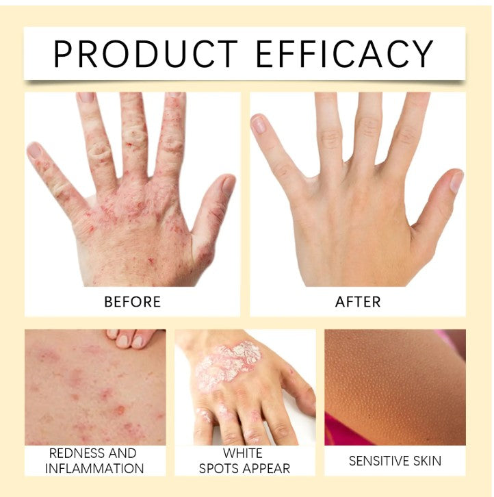 Bee White Spot Neck Cream - Natural Skin Repair for Neck Discoloration | Reduce White Spots & Even Skin Tone with Bee Venom